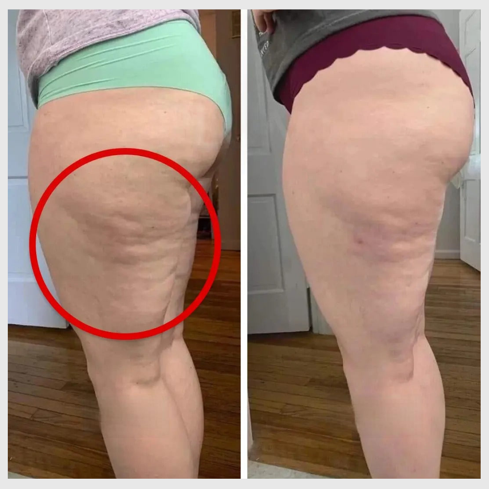 Photo avant après illustrant la réduction de la cellulite sur les cuisses après utilisation du legging 3D sculptant Zafora